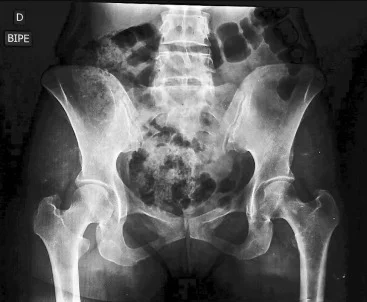 imagen-valor-de-radiografia-pelvis