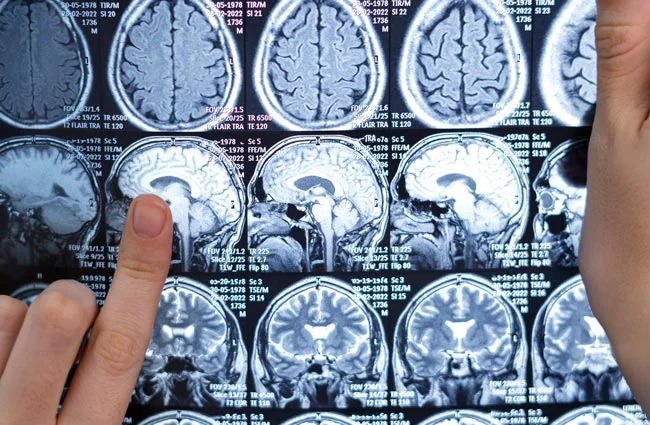 imagen-valor-de-tac-cerebral